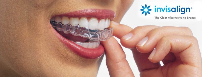 invisalign cost